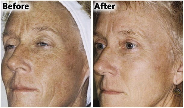 ipl lasen skin treatments